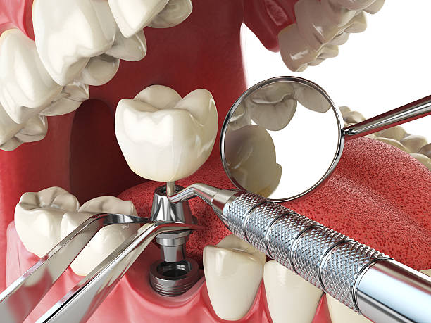 Best Emergency Dental Care for Broken or Chipped Teeth in Poquonock Bridge, CT